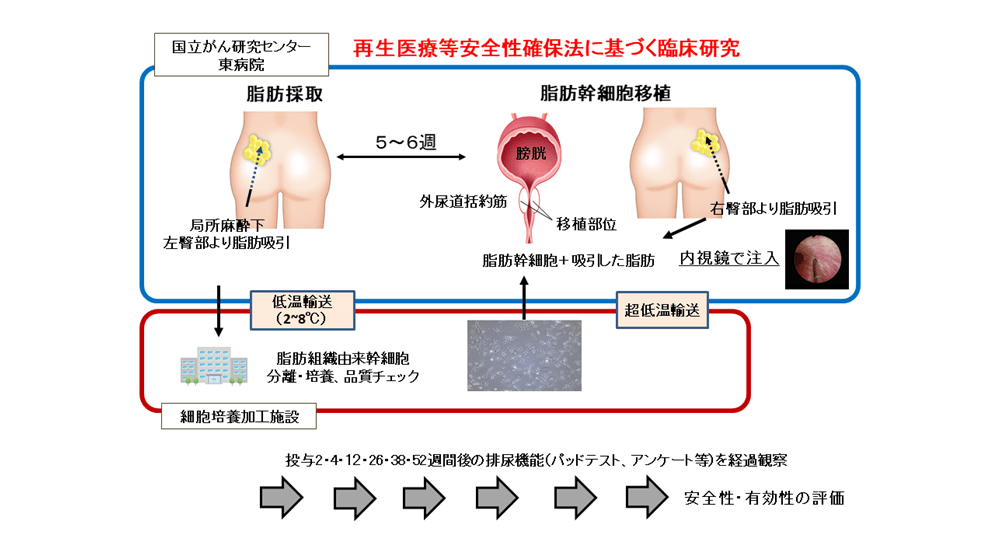 前立腺がんの術後合併症、尿失禁の克服を目指した再生医療を用いた臨床